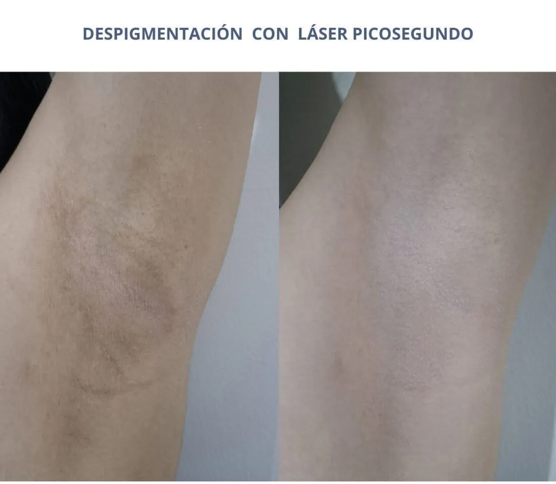 Before and after of a picosecond laser depigmentation treatment performed at HealTech